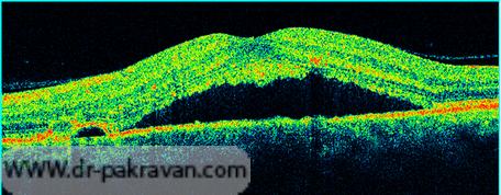 تجدا شدگی تمام ضخامت شبکیه از لایه های زیرین که در عکس  OCT به وضوح قابل تشخیص است.